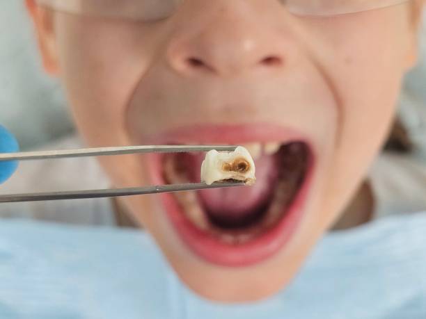 Best Emergency Dentist for Knocked-Out Tooth in Forrest, IL